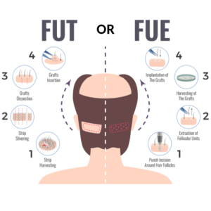 FUE vs FUT